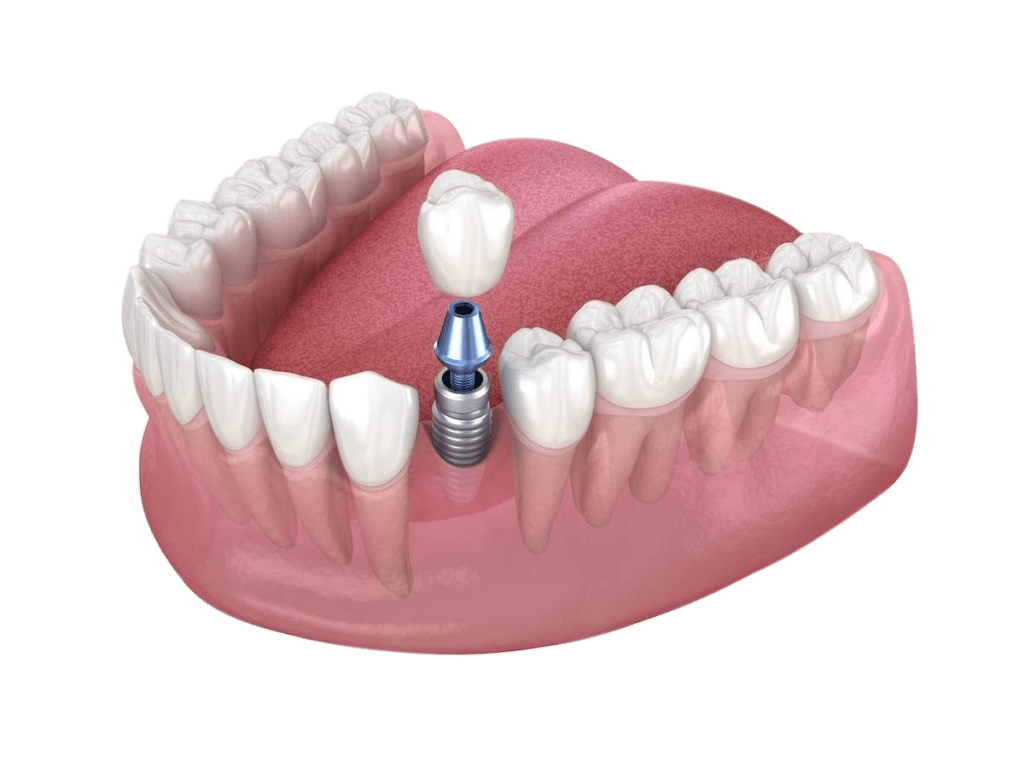 implante dental preço