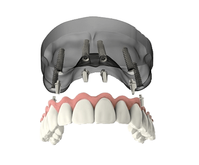 prótese-dental-fixa