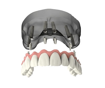 protese-dental